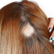 Alopecie estelle daves psychosomatique