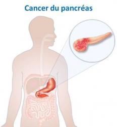 Cancer pancreas image 1