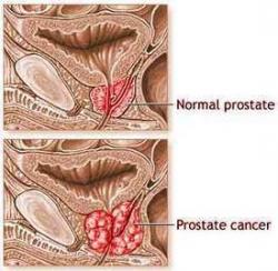 Cancer prostate 1