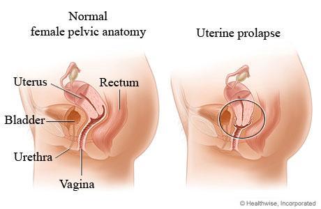 Descente de l uterus 1