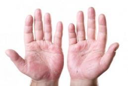 Eczema aux mains