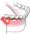 Abscess 1