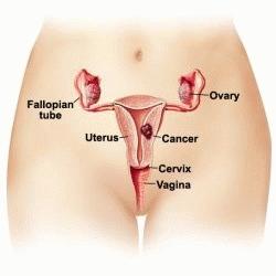 Cancer col uterus 1