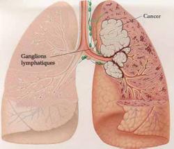 Cancer poumon 1