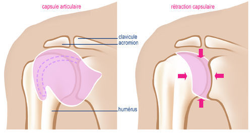 Capsulite 1