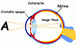 Cataracte 1
