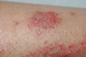 eczéma : symbolique, causes psychosomatiques, émotionnelles