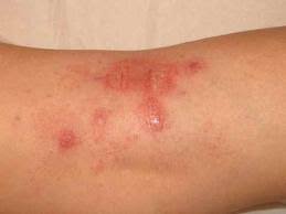 eczéma : symbolique, causes psychosomatiques, émotionnelles