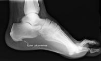 Epine calcaneenne psychosomatique