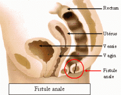 Fistule anale 1