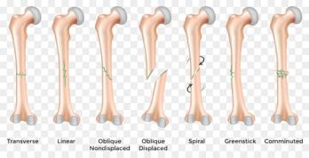Fracture symbolique