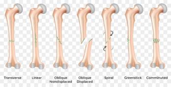 Fracture symbolique