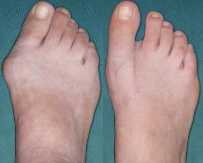 Hallux valgus