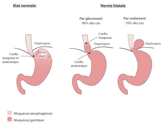 Hernie hiatale