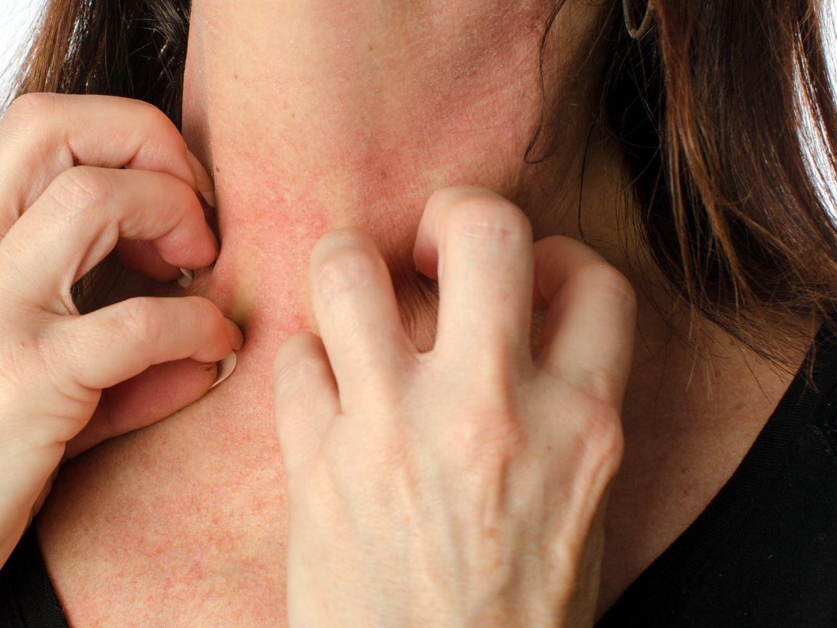 Eczéma symbolique au cou