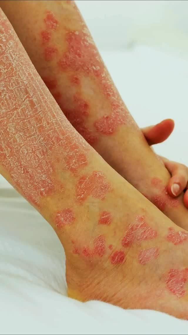 Symbolique ézcema dans les jambes