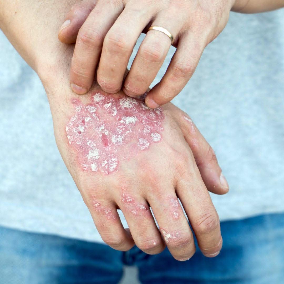 Symbolique ézcema dans les mains
