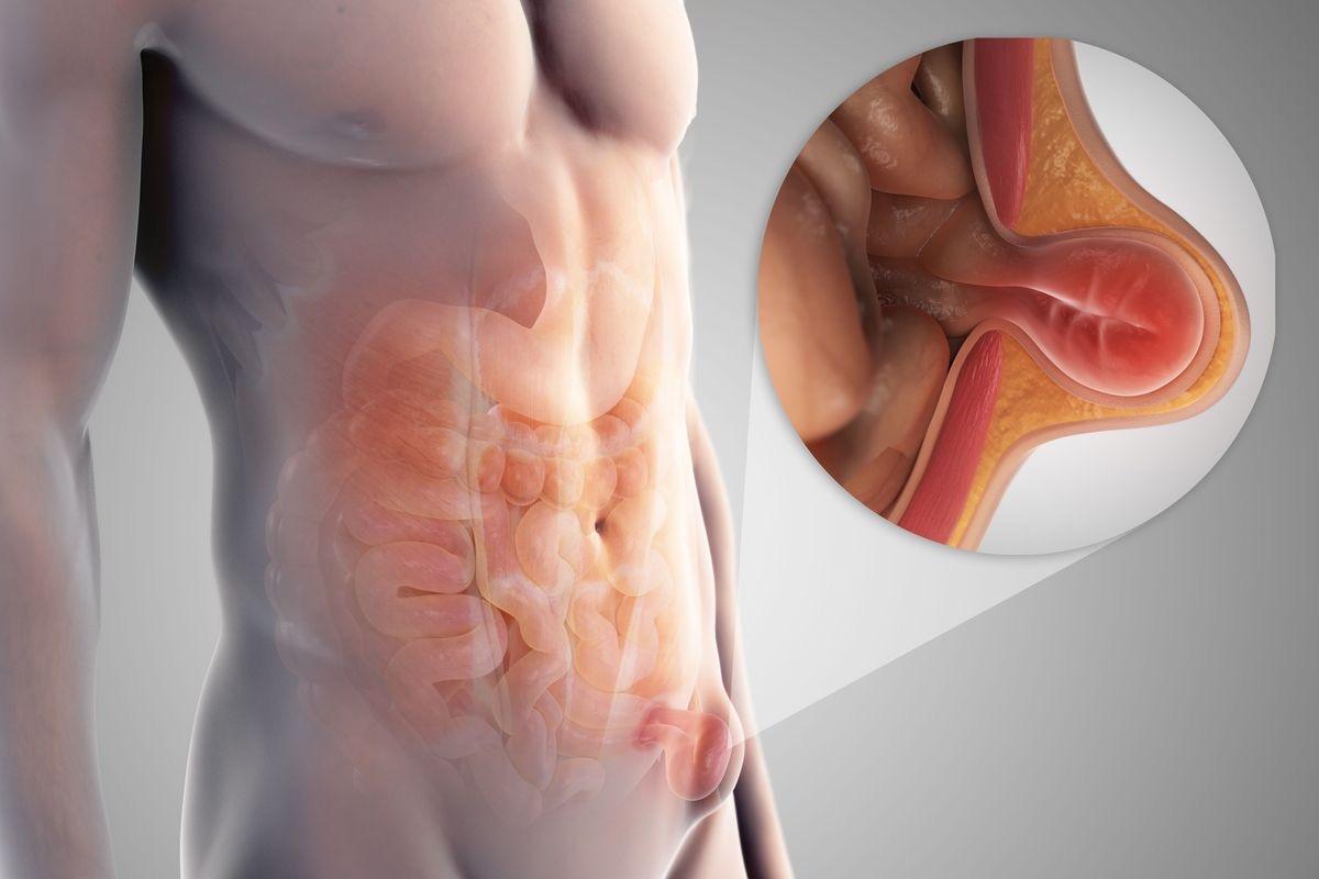 la symbolique Hernie inguinal LPE