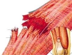 La symbolique de déchirure musculaire LPE