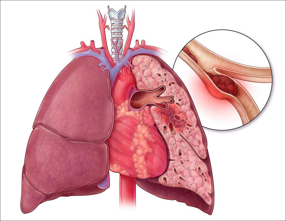 Symbolique de l'embolie pulmonaire selon LPE