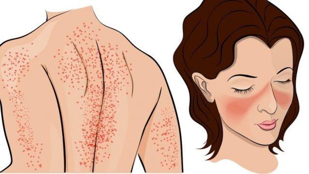 Symbolique du lupus selon LPE