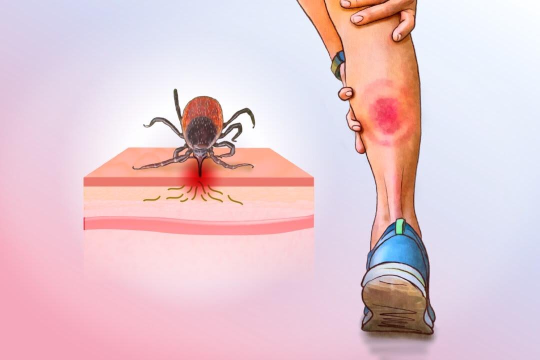 Symbolique Syndrome de Lyme selon la LPE