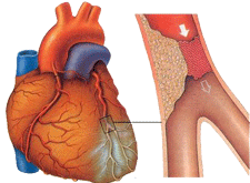 Infarctus 1