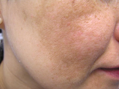 Melasma 1