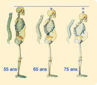 Osteoporose 1