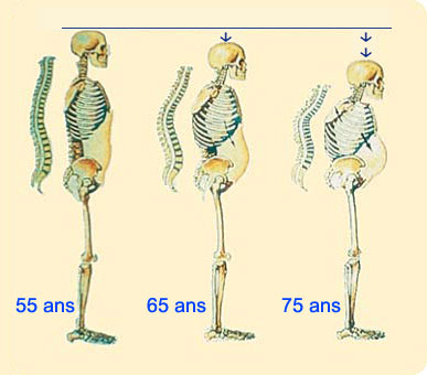 Ostéoporose : comprendre l'anatomie des os