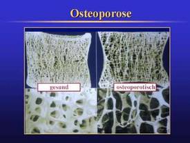 Osteoporose 2