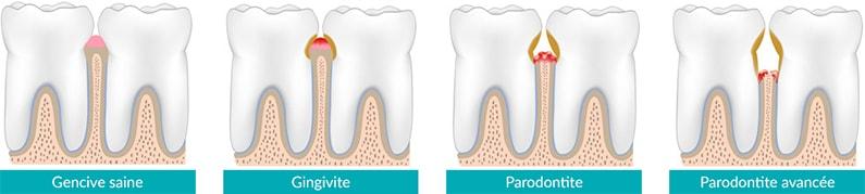 Parodontite