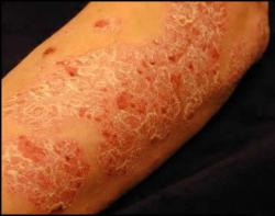 Psoriasis : symbolique, causes psychosomatiques, émotionnelles