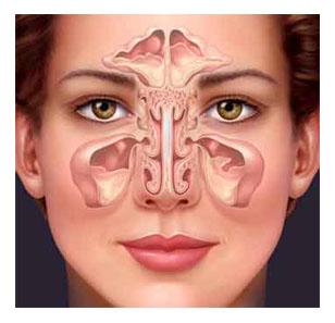 Inflammation des sinus frontaux (sinusite)