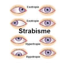 Strabisme 1