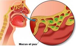 Symbolique de la sinusite