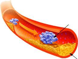 Thrombose