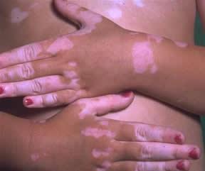 Vitiligo 1